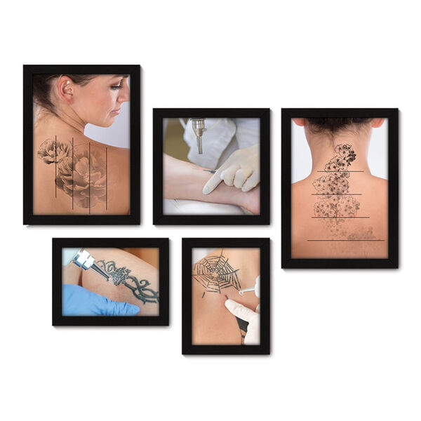 Kit Com 5 Quadros Decorativos - Remoção Tatuagem Tattoo - 131