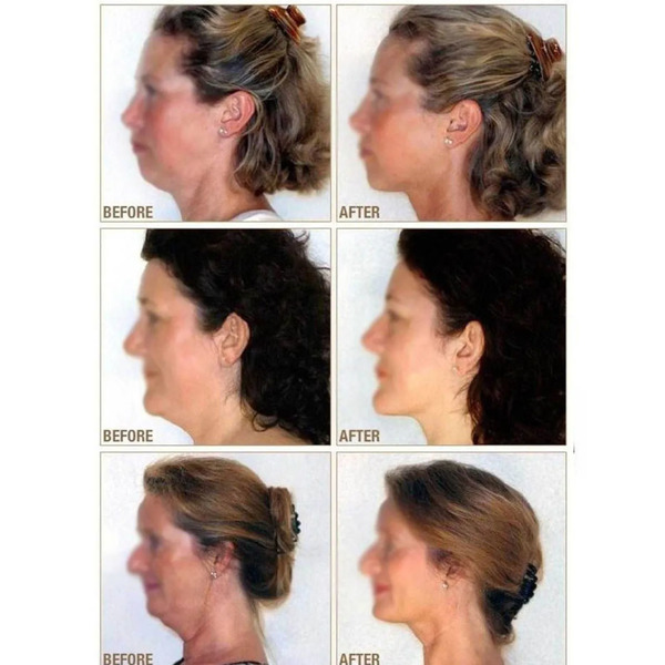 Massageador de papada funciona clearance