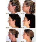 Remove Papada Massageador Pescoco Musculo Beleza Exercitador